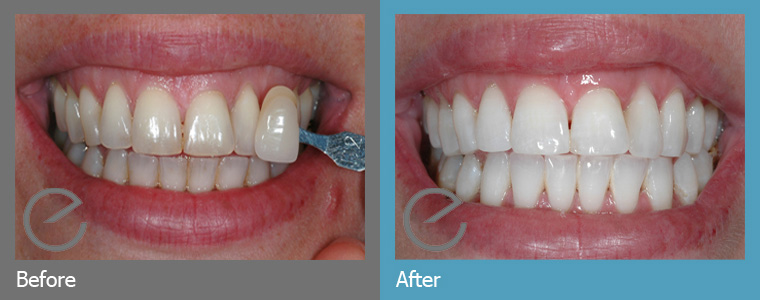 enlighten teeth whitening case 6 before after