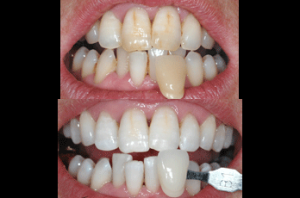 Laser teeth whitening kent