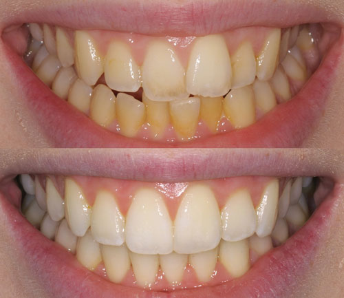 Inman aligner 9 weeks before and after