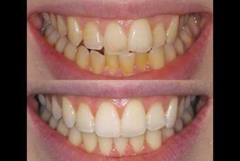 Inman aligner 9 weeks before and after