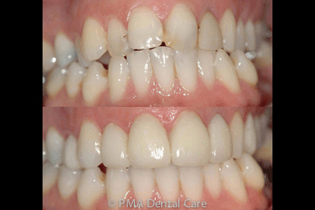 Before and After Enlighten Teeth Whitening Gravesend