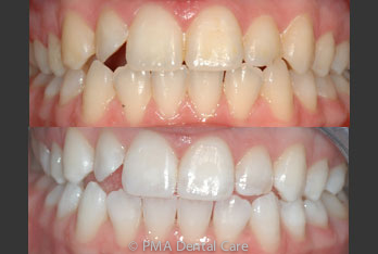 Before and After Enlighten Teeth Whitening Gravesend