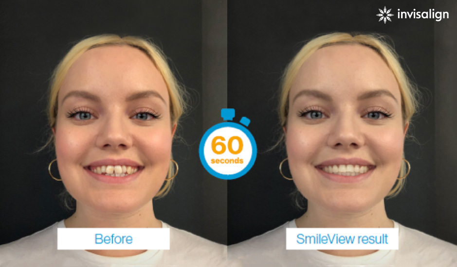 invisalign smileview before and after